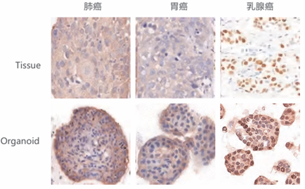 肺癌、胃癌和乳腺癌组织与类器官的 IHC 染色对比图