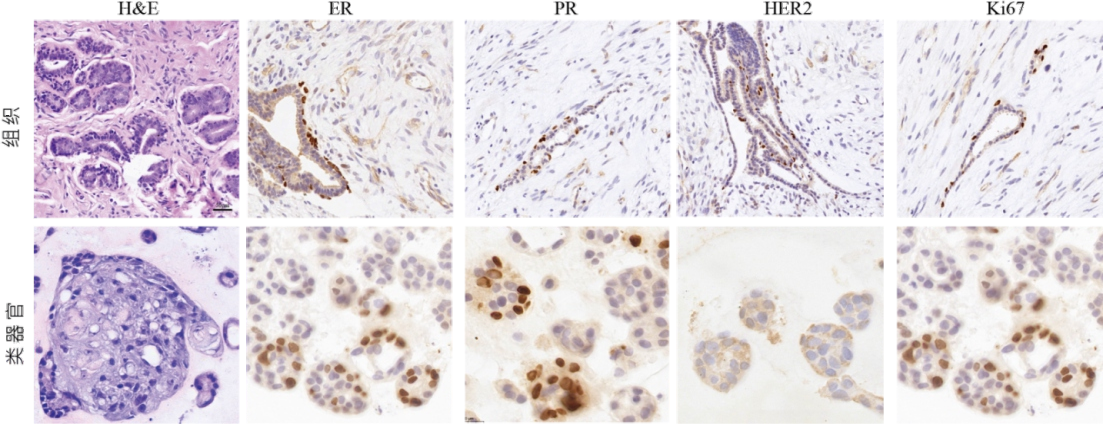 管腔B型（HER2阳性）乳腺癌类器官的IHC染色结果显示，类器官与来源肿瘤组织在ER、PR、HER2以及Ki67等标志物具有相似的表达模式。